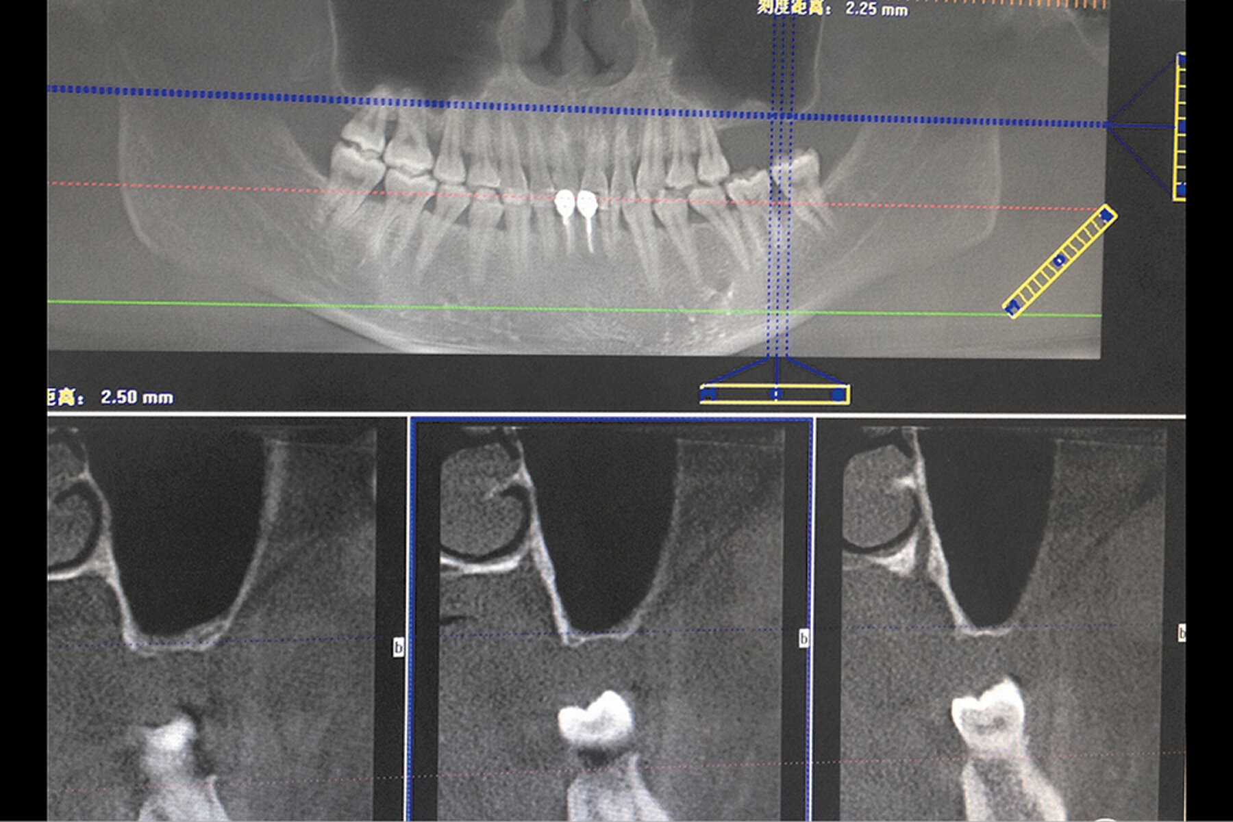 Geistlich Usa Crestal Sinus Floor Elevation